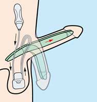 Hydraulisches Schwellkörperimplantat