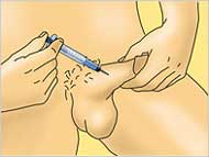 Schwellkörper-Autoinjektionstherapie (SKAT)